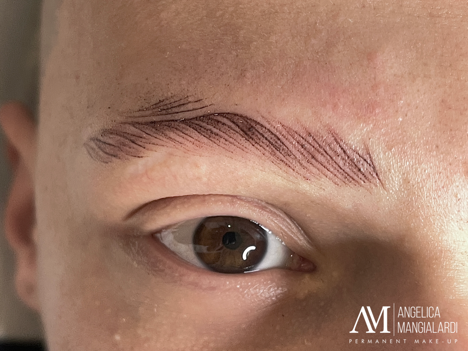 Sopracciglia Alopecia Sopracciglia Alopecia
