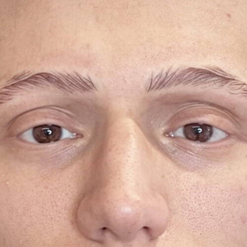 Corso Di Dermpigmentazione Su Alopecia