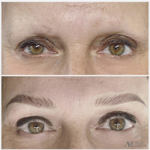 Corso Di Dermpigmentazione Su Alopecia